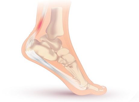 clarks shoes for achilles tendonitis