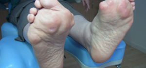 best sandals for arthritic feet