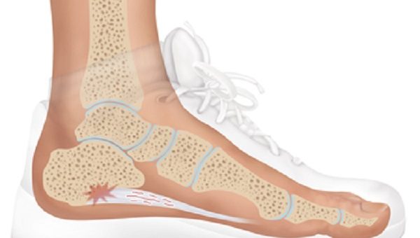 Crocs sandals for Plantar Fasciitis