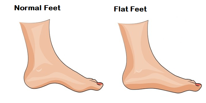 Flip Flops for Flat Feet