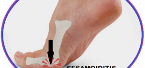 sandals for Sesamoiditis