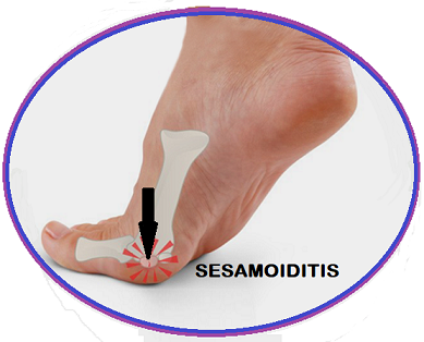 sandals for Sesamoiditis