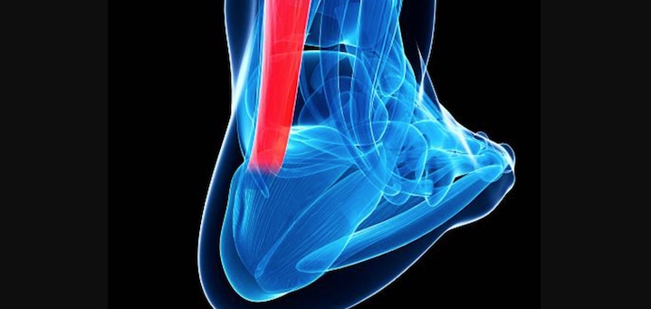 Achilles Tendonitis Illustration