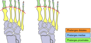 Birkenstock Sandals for Morton's Neuroma