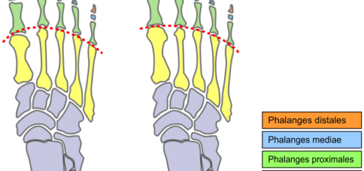 Birkenstock Sandals for Morton's Neuroma