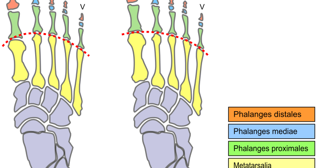 Birkenstock Sandals for Morton's Neuroma