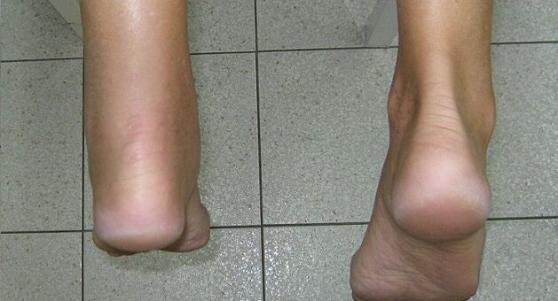 Skechers Sandals for Achilles tendonitis