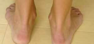Merrell Sandals for Achilles Tendonitis