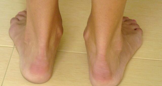 Merrell Sandals for Achilles Tendonitis