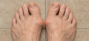 Best Sandals for Bunions Featured Image