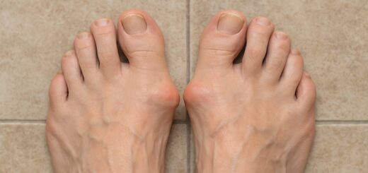 Best Sandals for Bunions Featured Image