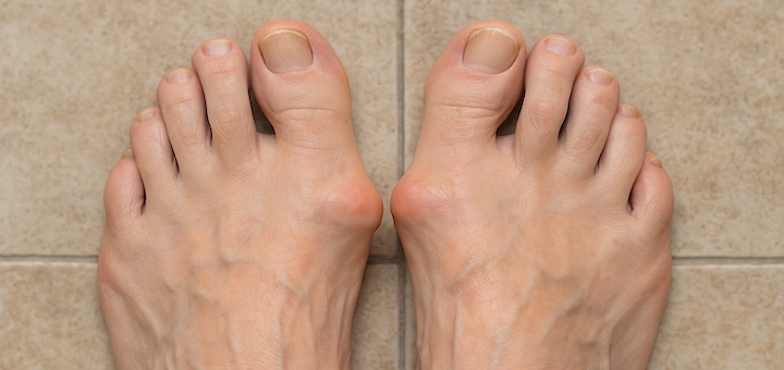 Best Sandals for Bunions Featured Image