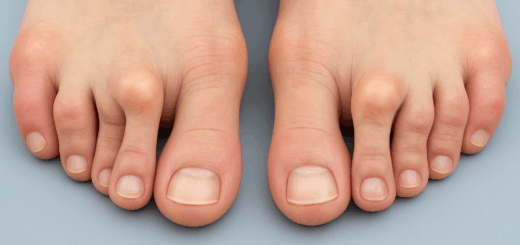 Best Sandals for Hammer Toes Featured Image