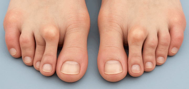 Best Sandals for Hammer Toes Featured Image Best Sandals for Hammer Toes Featured Image