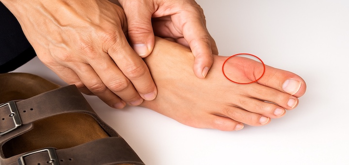 Birkenstock Sandals for Hallux Rigidus Featured Image