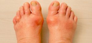 Arthritic Feet Relief Sandals Featured Image