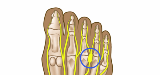 Morton’s Neuroma Relief Featured Image